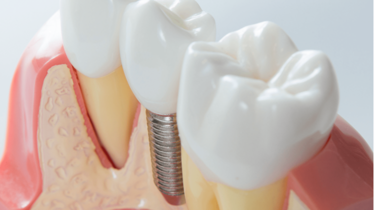 dental implants Alexandria