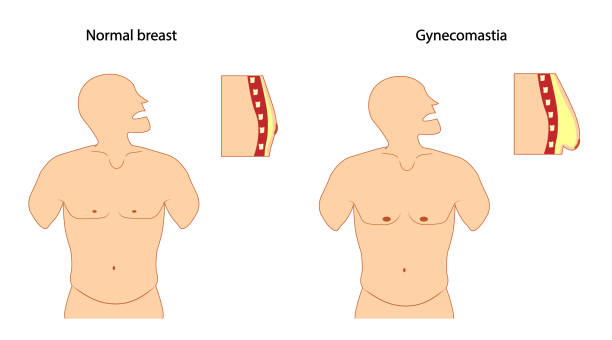 Gynecomastia in Al Ain